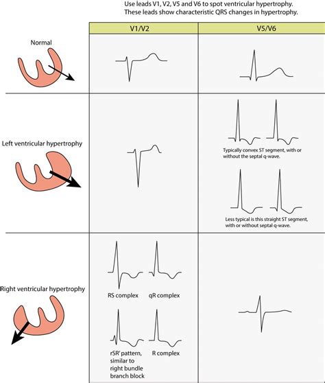 left ventricular hypertrophy ecg meaning.